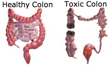 healthy-colon-toxic-colon