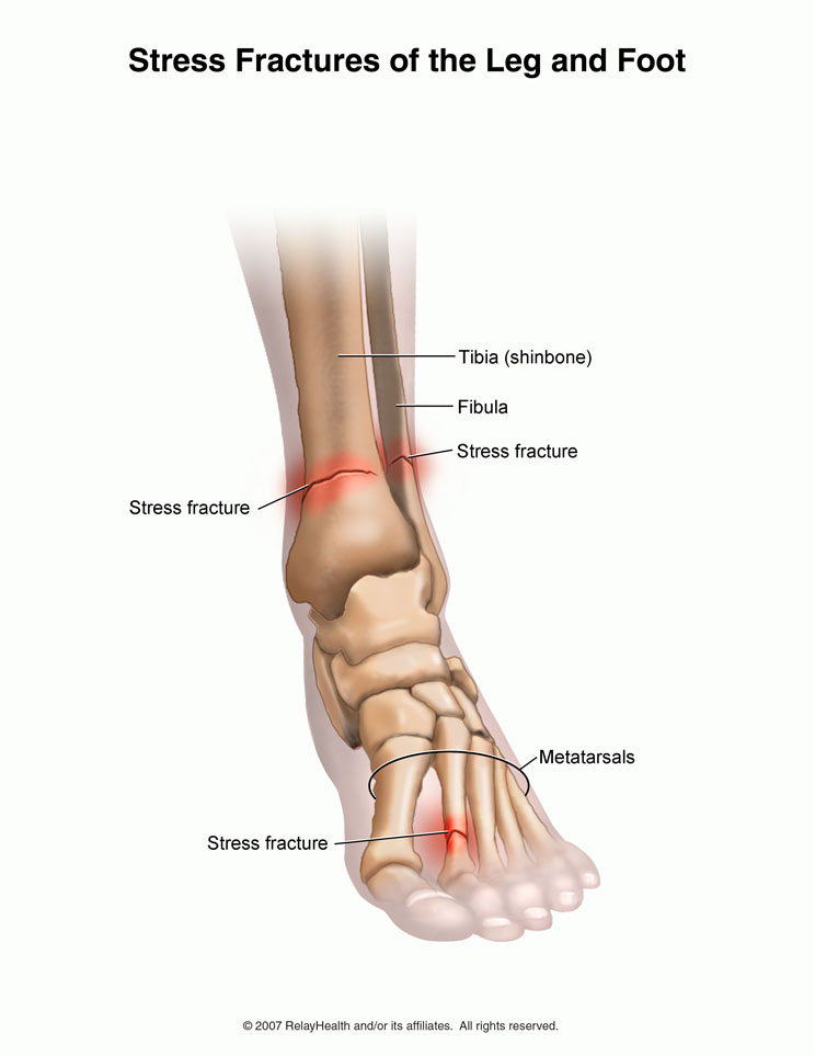 Cum să reduci durerea în picioare în timp ce alergi, Articulația pe picior doare după alergare